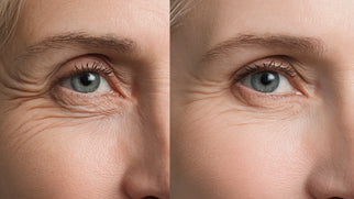 Botox for Under-Eye Bags: Aesthetic Strategy and Treatment Guide Picture