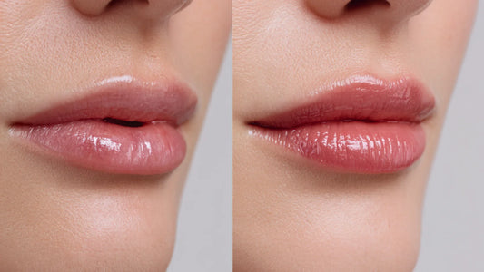 Bad Lip Filler: Causes, Corrections, and How to Avoid Lip Filler Gone Wrong