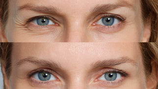 Botox for Ptosis: Results, Benefits, and Risks Explained Picture