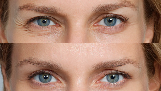 Botox for Ptosis: Results, Benefits, and Risks Explained