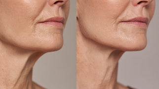 Botox for Sagging Jowls: How It Works, Results, and Expert Injector Tips Picture