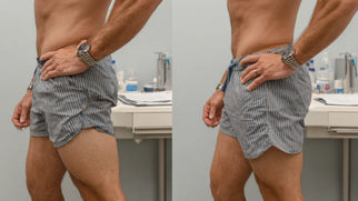 Butt Augmentation for Men: Safe Injection Techniques and Aesthetic Strategy Picture