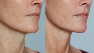 Non-Surgical Neck Lift vs Surgical | Best Lifting Options Compared Picture