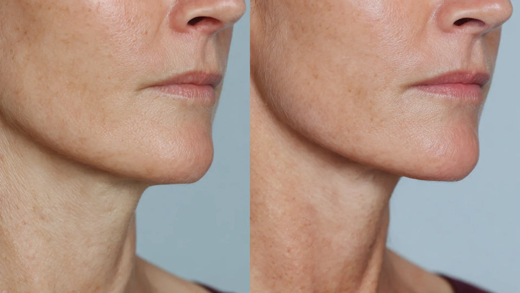 Non-Surgical Neck Lift vs Surgical | Best Lifting Options Compared