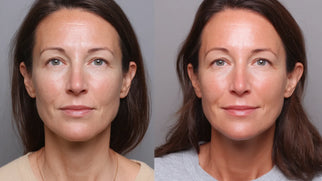 Ozempic Face Before and After | Causes & Facial Volume Restoration Picture
