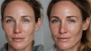 Too Much Cheek Filler | Signs, Risks & Safe Reversal Options Picture