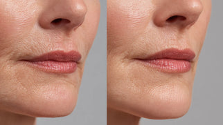 Treating Vertical Lip Lines | Best Filler Techniques & Results Picture