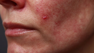 Filler Granuloma: Causes, Diagnosis & Safe Treatment Picture