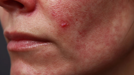 Filler Granuloma: Causes, Diagnosis & Safe Treatment