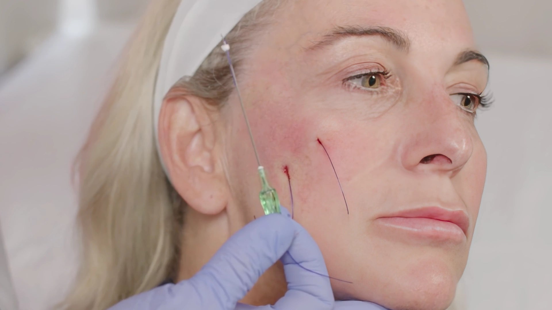 Advanced PDO Thread Lift Training (Level III)—Online Training - Empire ...