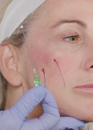 Advanced PDO Thread Lift Training (Level III)—Online Training