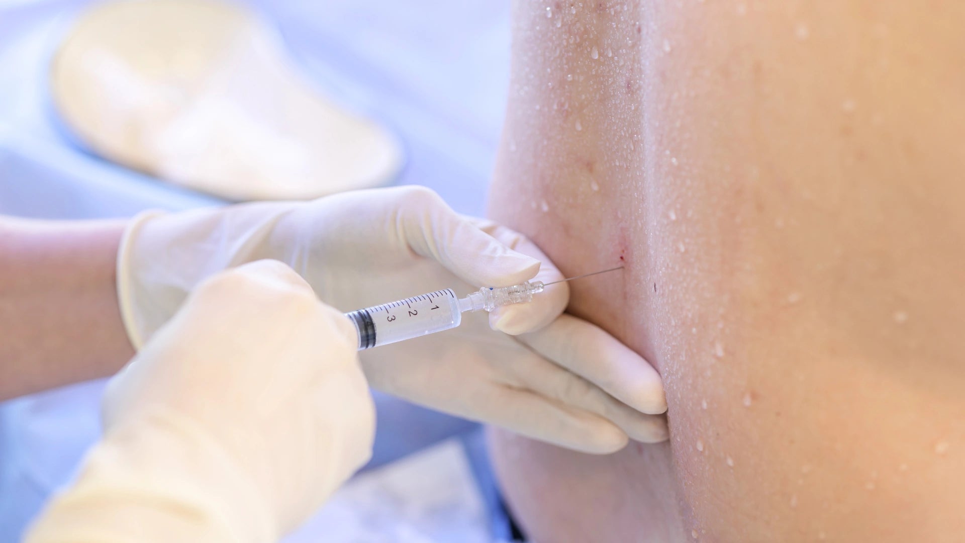 Mastering Lumbar Epidural Injections: A Virtual Guide for Interventional Pain Management Picture