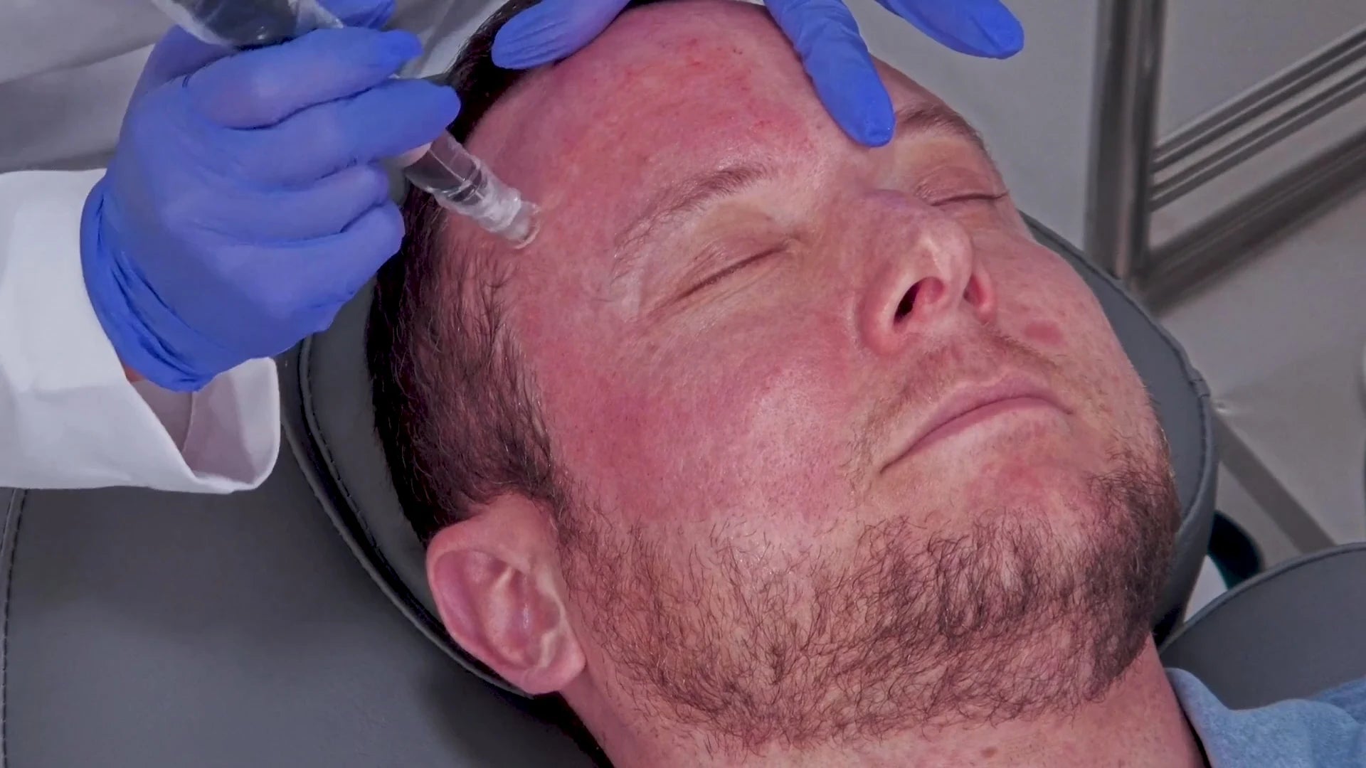 Microneedling 2 Picture