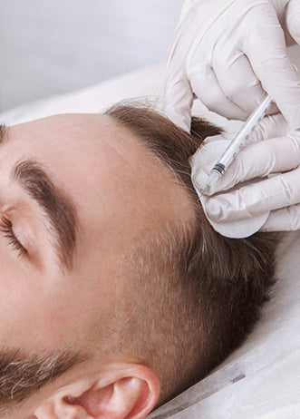 PDO Threads and PRP for Hair Restoration