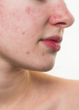 Erase Acne Scars: Achieve Total Skin Renewal with Plexrplasty and Act O' Feel Workshop Picture