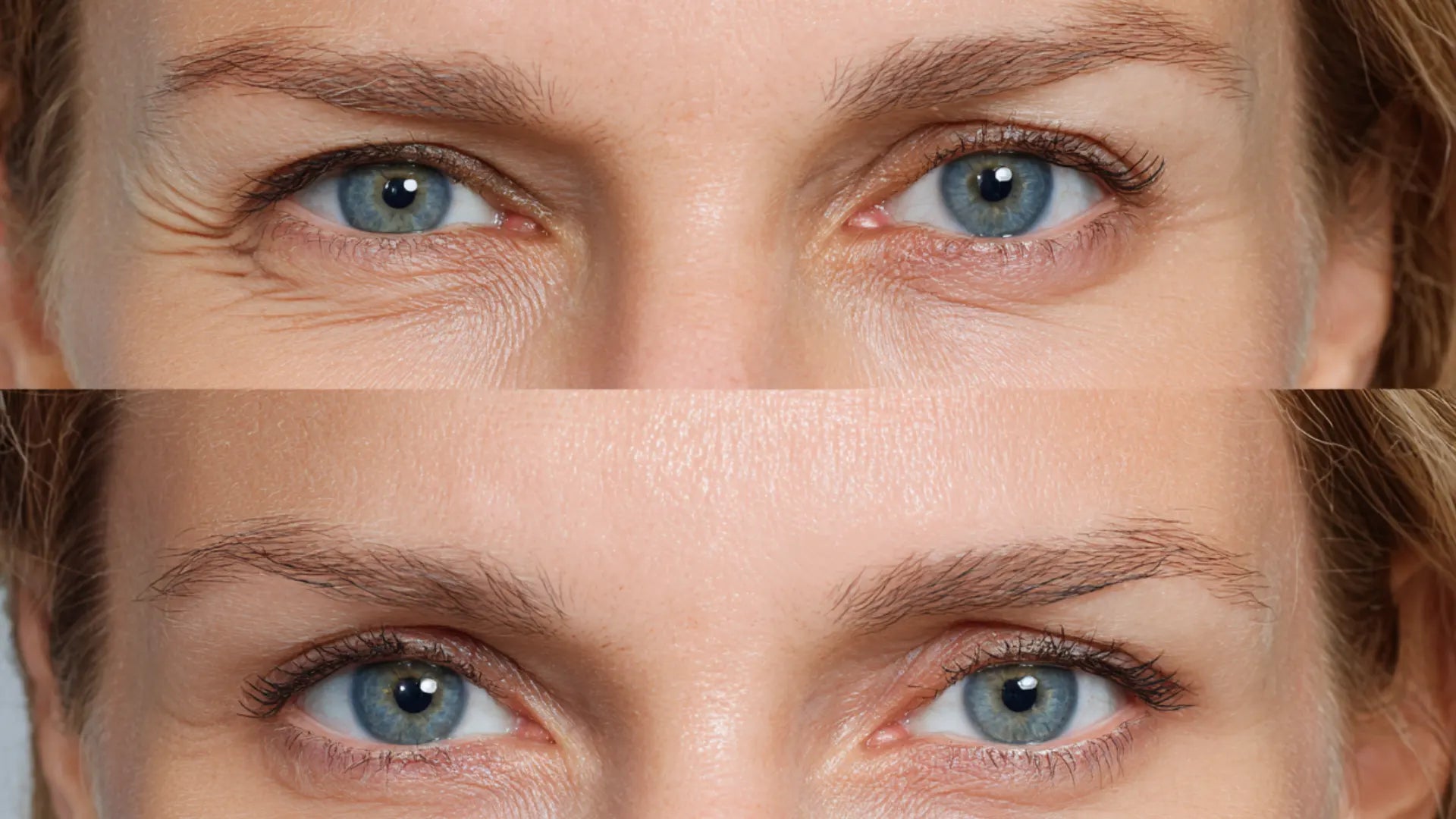 Comparison showing upper eyelid droop following Botox injection.