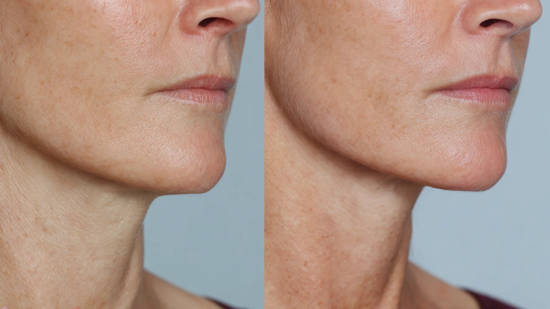 Before and after comparison showing subtle non-surgical lift versus surgical outcomes.
